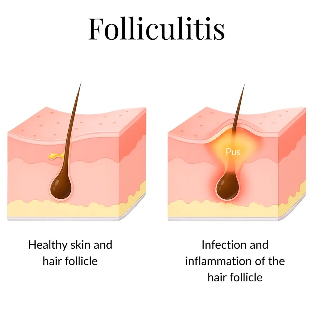 Treating Folliculitis After Waxing in NYC
