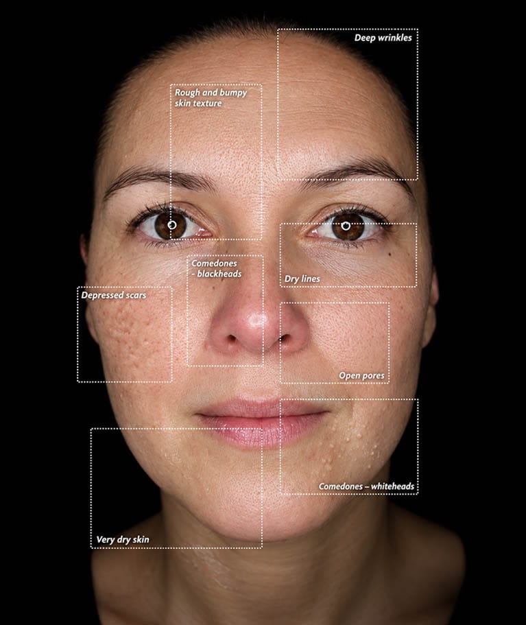 Facial skin assessment showing fine lines, wrinkles, uneven texture, enlarged pores, and dryness at ila Only Spa in Midtown Manhattan.